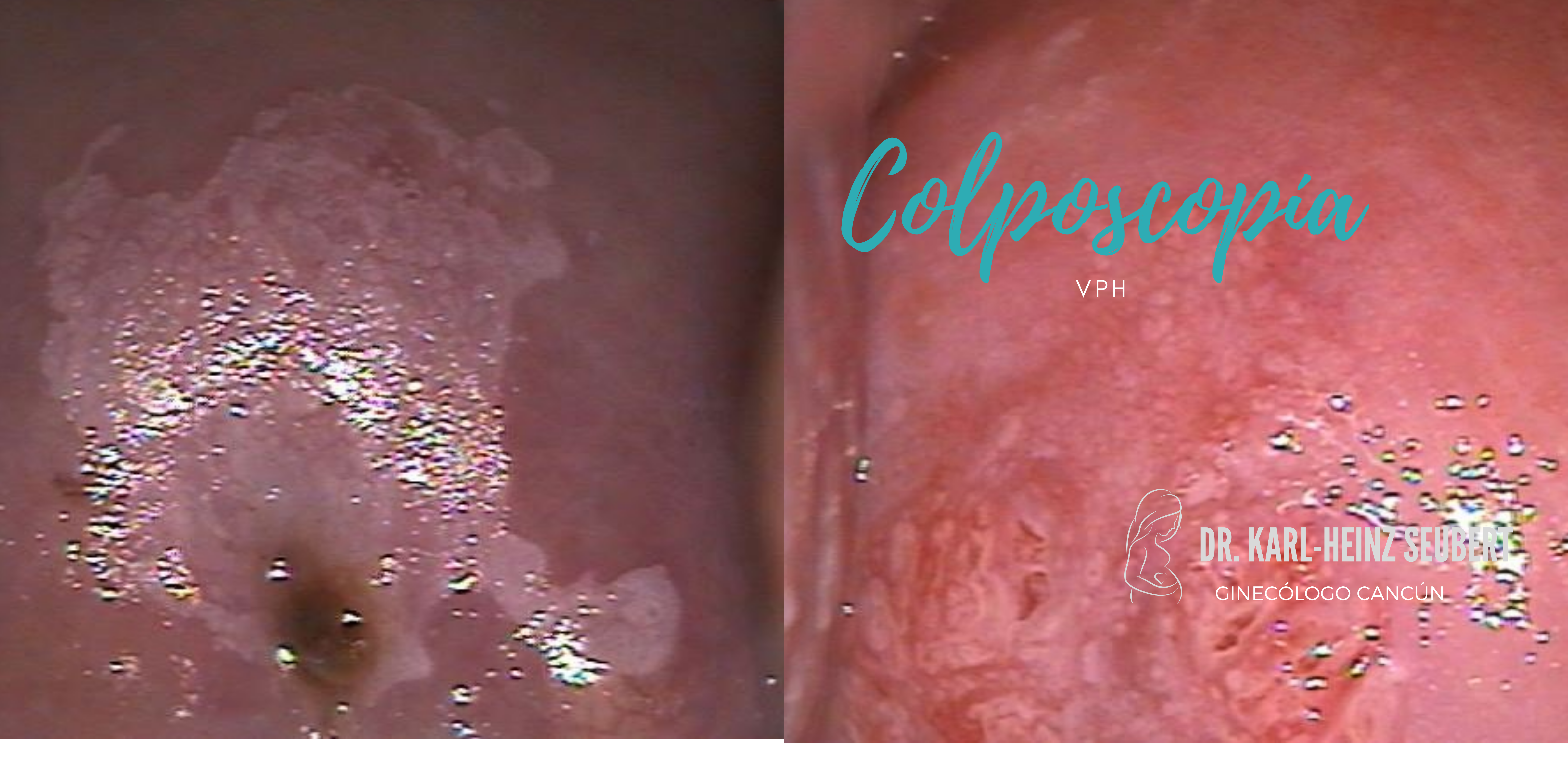 ginecologo Cancún, colposcopia, vph